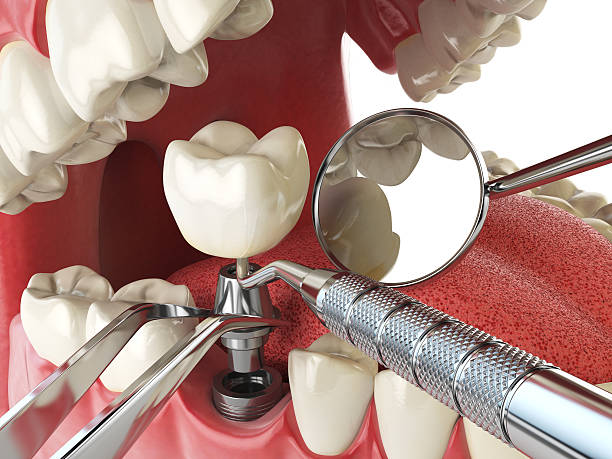 Best Emergency Wisdom Teeth Removal in Norman Park, GA